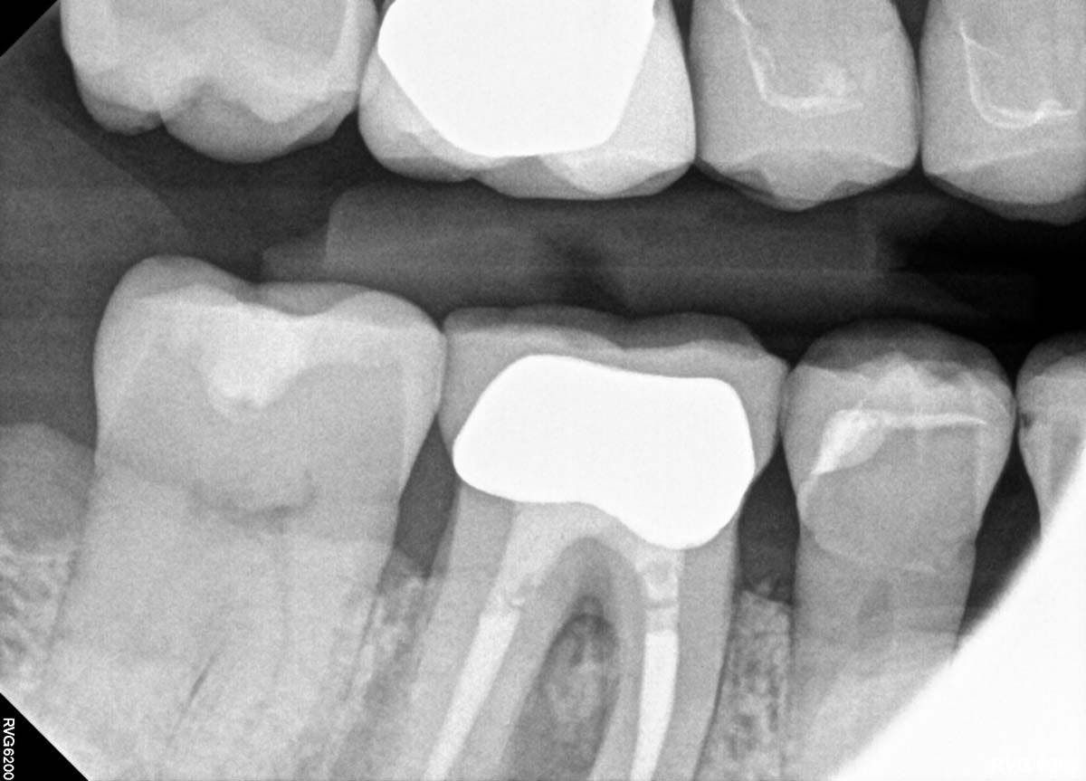 A look at patient's periapical x-rays.