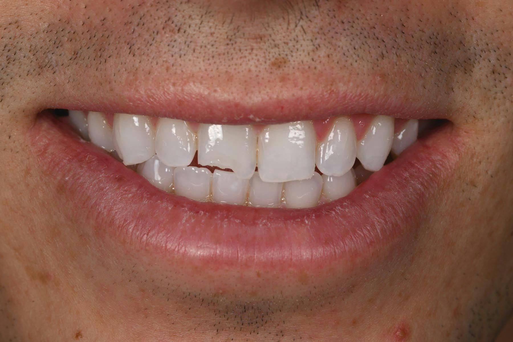 Using a Simplified 2-Layer Technique to Restore a Fractured Maxillary Central Incisor | Image Credit: © Ivoclar
