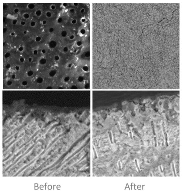 Electron micrographs showing before and after treatment with CrystLCare which reduces sensitivity through occlusion of dentinal tubules. | image Credit: © Greenmark Biomedical Inc.