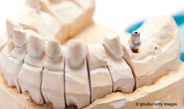 The latest options in dental implants