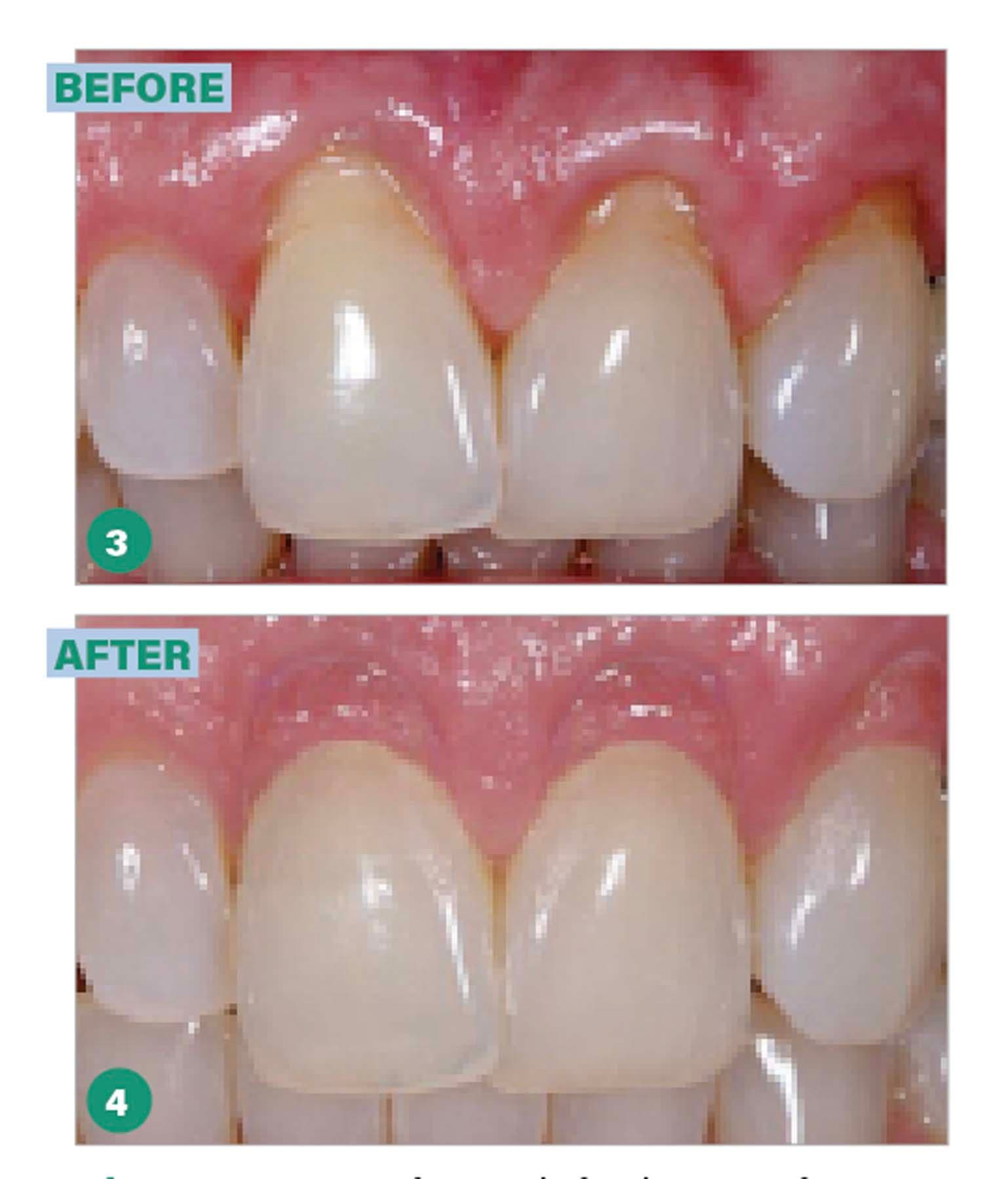 Figures 3 & 4. Before and after images of a case using Beautifil II Gingiva from Frank Milnar, DDS, AAACD. 