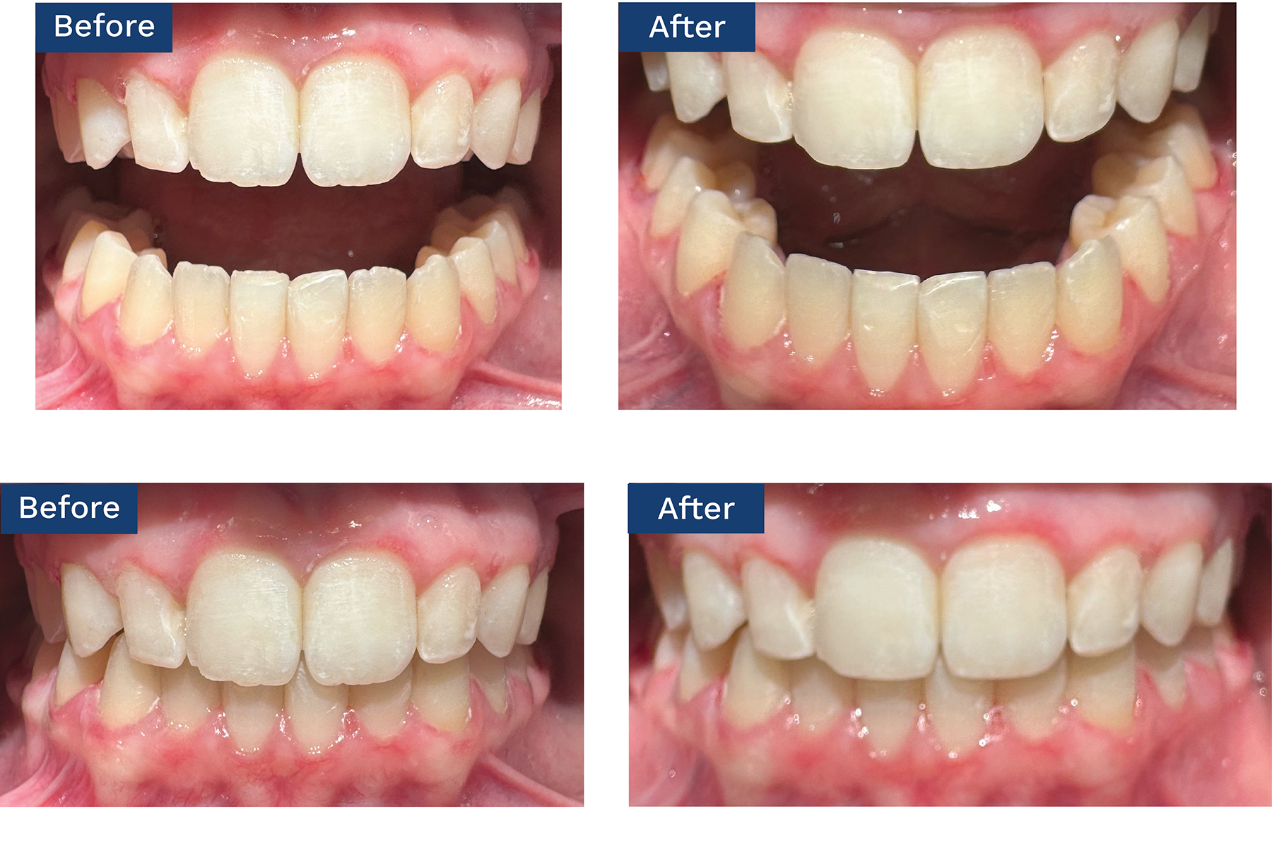 An example of how a patient can benefit from the esthetic enhancements provided by combining enameloplasty with clear aligner treatment | Image Credit: © Robert M. Stern, DMD