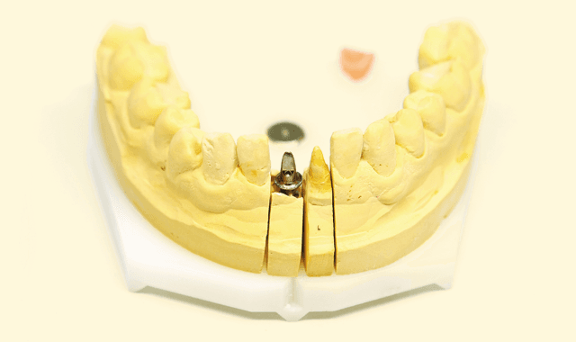 Implanting success: The state of dental implants