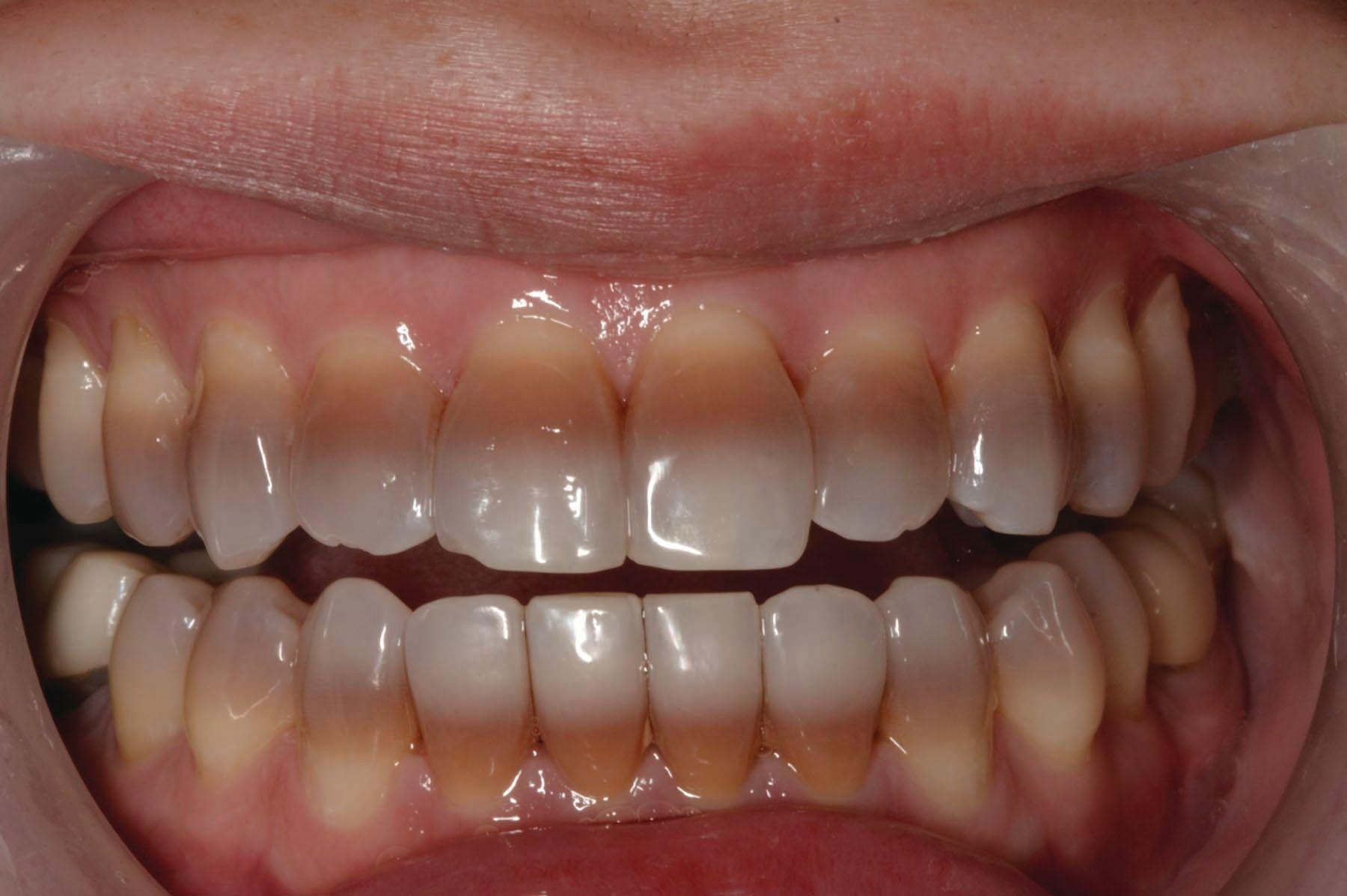 Restoring Severe Tetracycline-Stained Teeth and Correcting Protruding Anterior Teeth