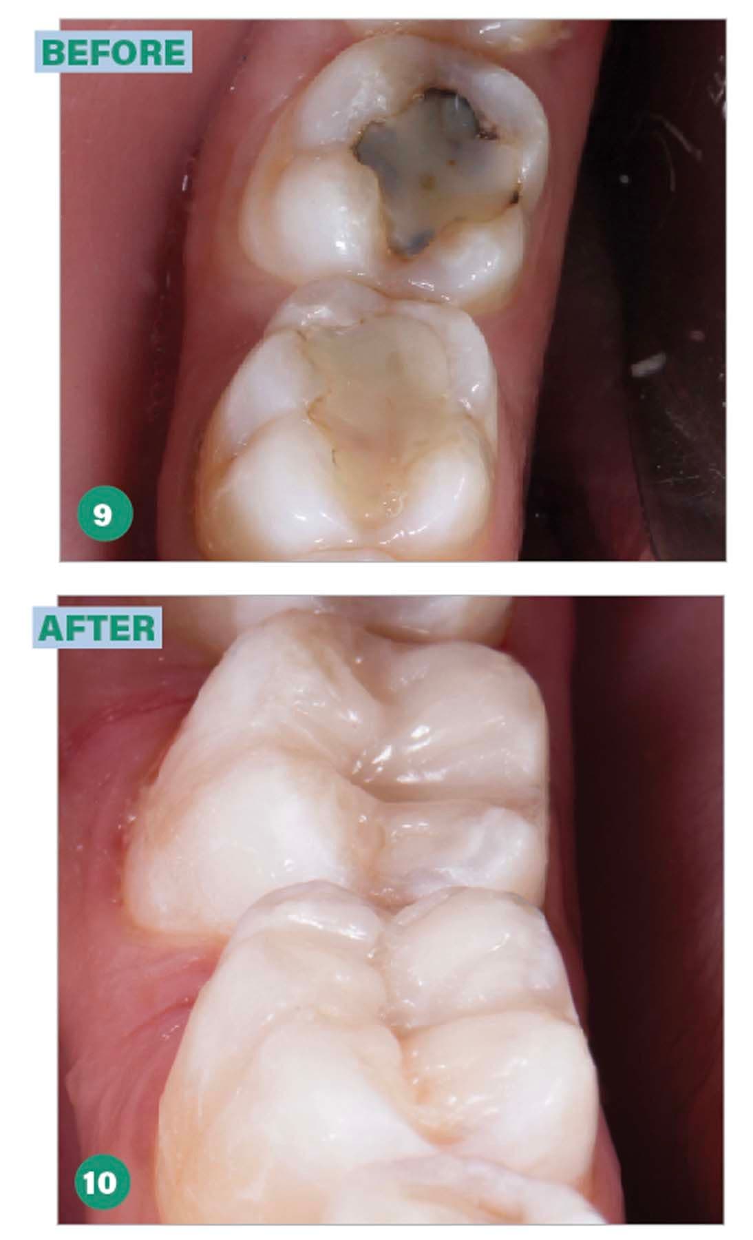 Figures 9 & 10. Flavio Henriques, DDS, MS, PhD, used Beautifil II LS for this restoration.