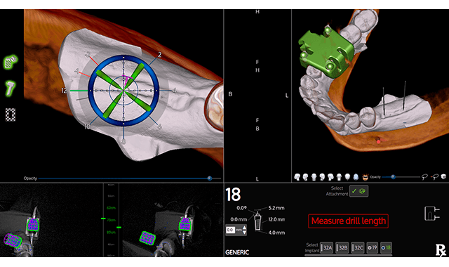 X-Nav receives FDA clearance for X-Mark technology