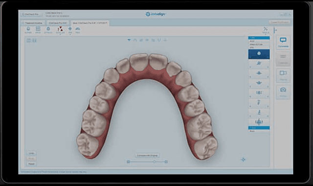 Align expands platform with ClinCheck Pro 6