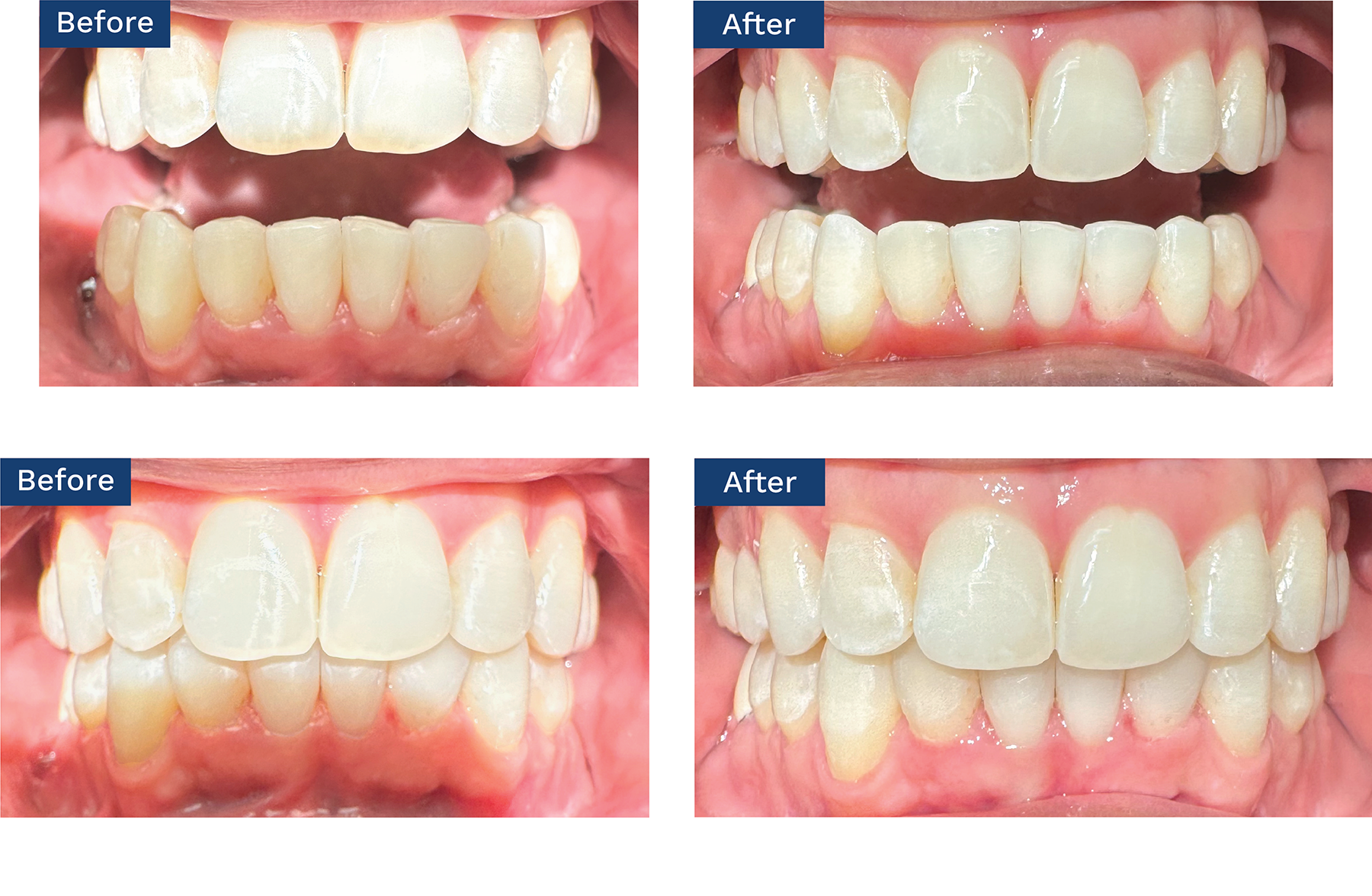 Esthetic Enameloplasty With Clear Aligner Treatment | Image Credit: © Robert M. Stern, DMD
