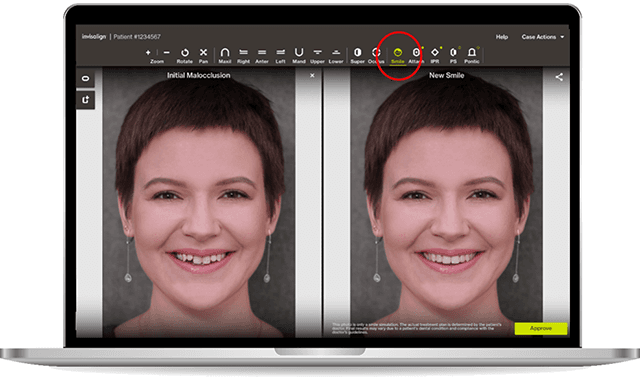Invisalign releases ClinCheck Visualization tool for Go system