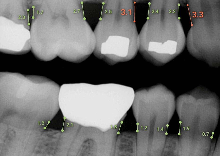 Overjet Dental Assist 