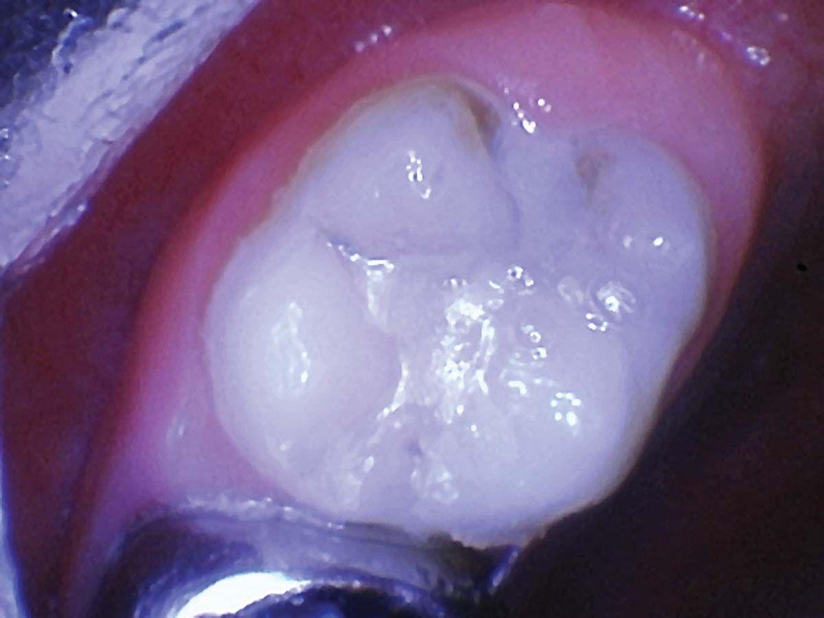 Noninvasive Caries Intervention Using Silver Diamine Fluoride. Image credit: © Centrix