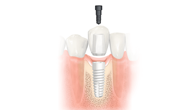 Nobel Biocare premieres NobelPearl implant system