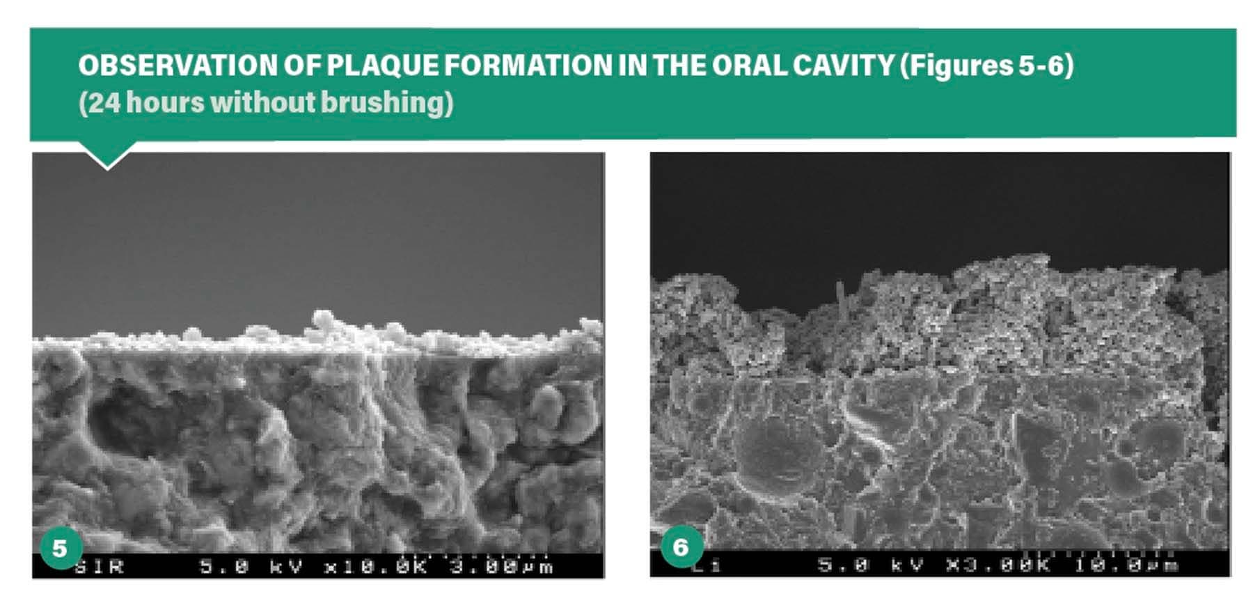 Figure 5. Minimal bacterial colonization (Giomer Technology).  Figure 6. Advanced bacterial colonization (conventional composites).  | Image Credit: © Shofu Dental Corp.