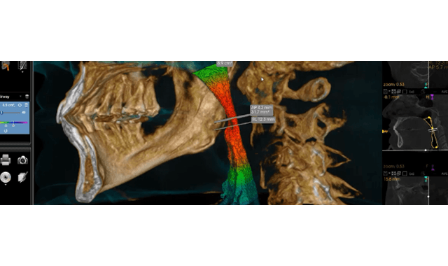 Carestream Dental launches CS Airway module