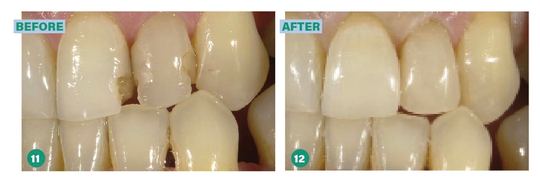 Figures 11 & 12. Beautifil Flow Plus X case from Paiman Lalla, DDS, AEGD, FICOI, FAAIP. 