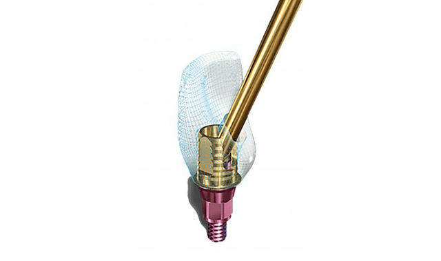 Implant Direct launches new Ti base abutments, SMARTbase