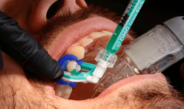 Treating proximal caries lesions with DMG Icon