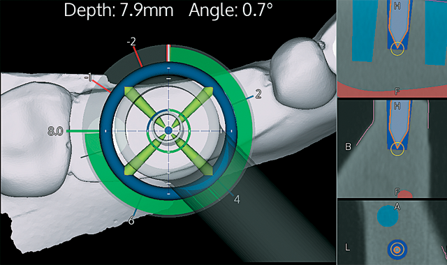 Applying the X-Guide Dynamic 3D Navigation system in your practice