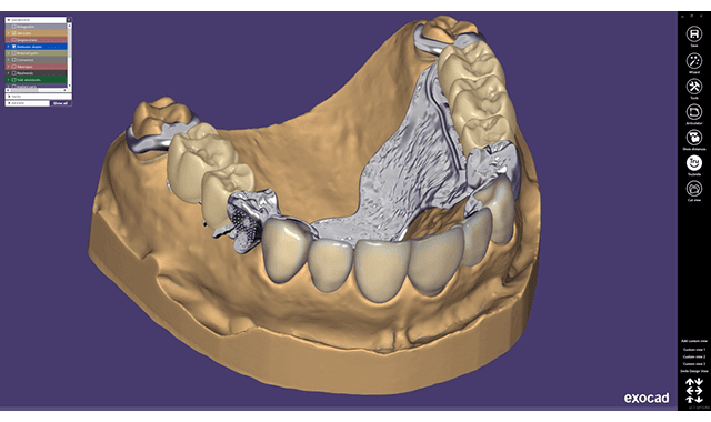 Dentsply Sirona announces extensive cooperation with exocad