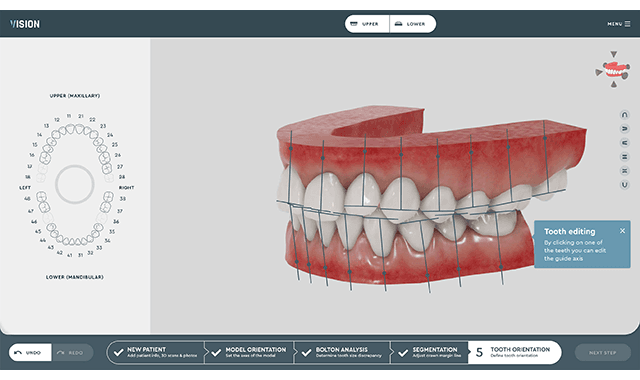 SoftSmile announces platform for aligner modeling