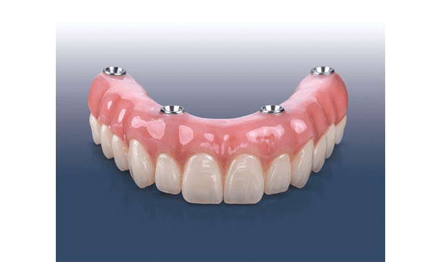 Glidewell introduces esthetic zirconia version of BruxZir Implant Prothesis